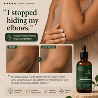 Depigmentation Solution