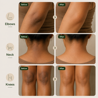 Depigmentation Solution